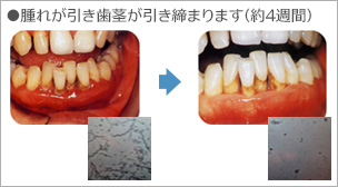 歯周病（歯肉炎・歯槽膿漏）の治療例